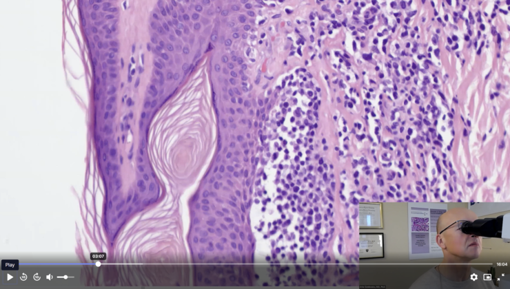 Unusual rash with CD30-positive epidermotropic infiltrate
