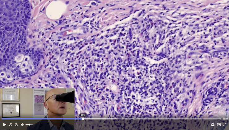 Cassic example of granuloma faciale. Dermpedia