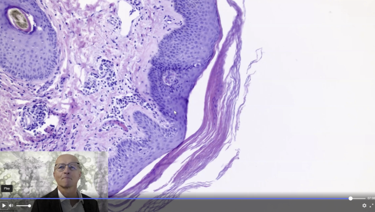 Annular Rash With Histology Of Pityriiasis Rosea