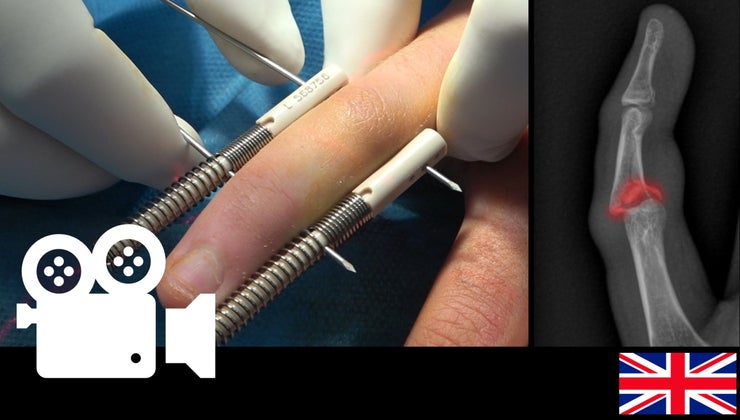 Complex fracture dislocation of the Proximal Interphalangeal Joint ...