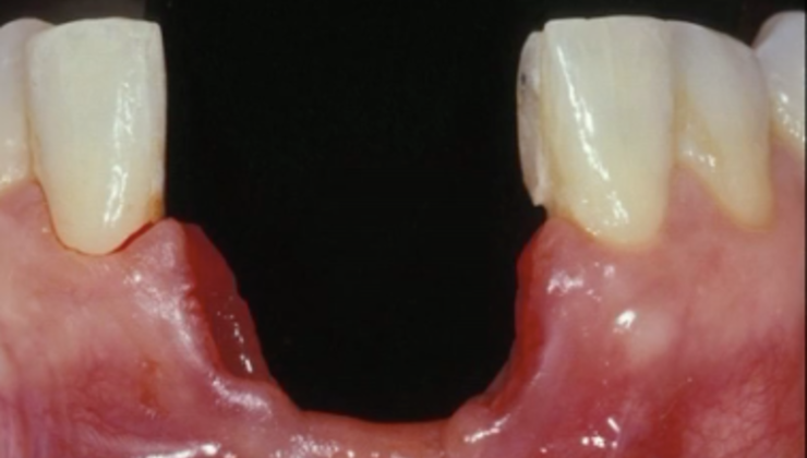 CLINICAL VIDEO The treatment of an anterior lower severely resorbed ...