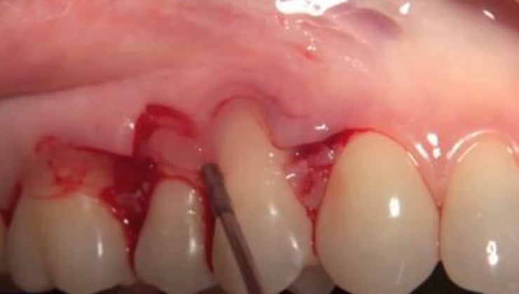 Single Recession Defect CLINICAL VIDEO - Single tooth gingival recession treatment using a ...
