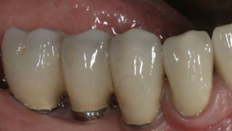 CLINICAL VIDEO Vertical Ridge Augmentation (Part 1): 1-stage Vertical ...