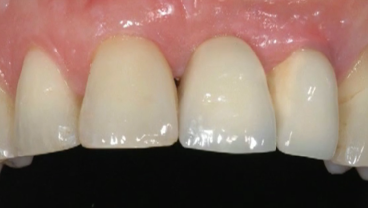 Verticle Ridge Line CLINICAL VIDEO Vertical Ridge Augmentation - 2-Stage Vertical Ridge Aug ...