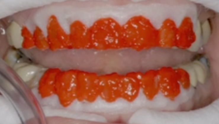 Comparison and Contrast of Direct vs. Indirect Anterior Restorations in ...