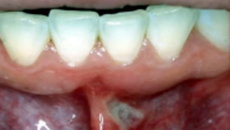 A-Z of Dental Hygiene Part 03 - Oral Pathology and Clinical ...