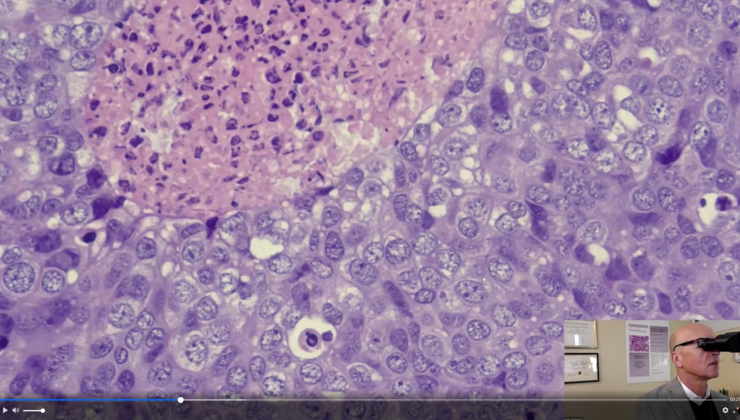 Extraocular Cancer Ocular Tumor In An Extraocular Location