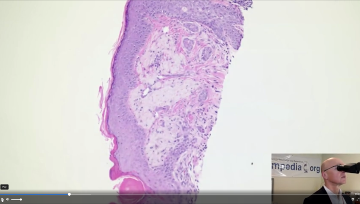 Superficial Portion Of Atypical Squamous Proliferation