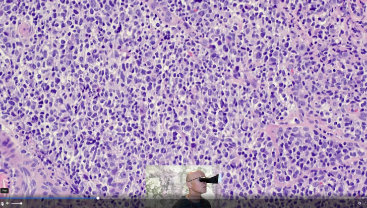 Non Melanoma Skin Cancer But Atypical Lymphoid Infiltrate On He