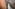 Moses Atieli's smothered dead, rotten jiggers removed #1 (Oct 1st 2025)