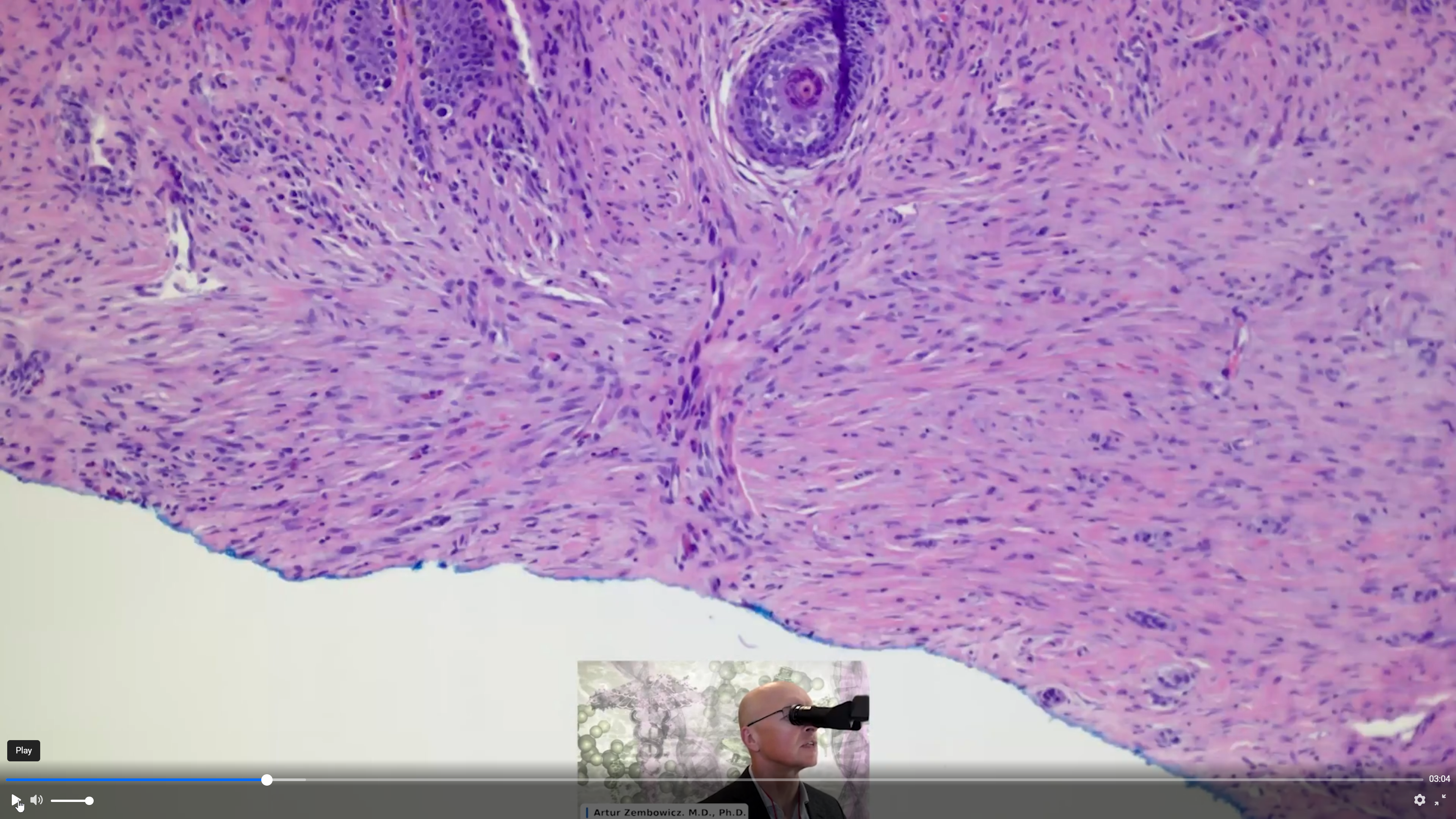 Severely Atypical Melanocytic Tumor With Dermal Component Of Uncertain  Significance
