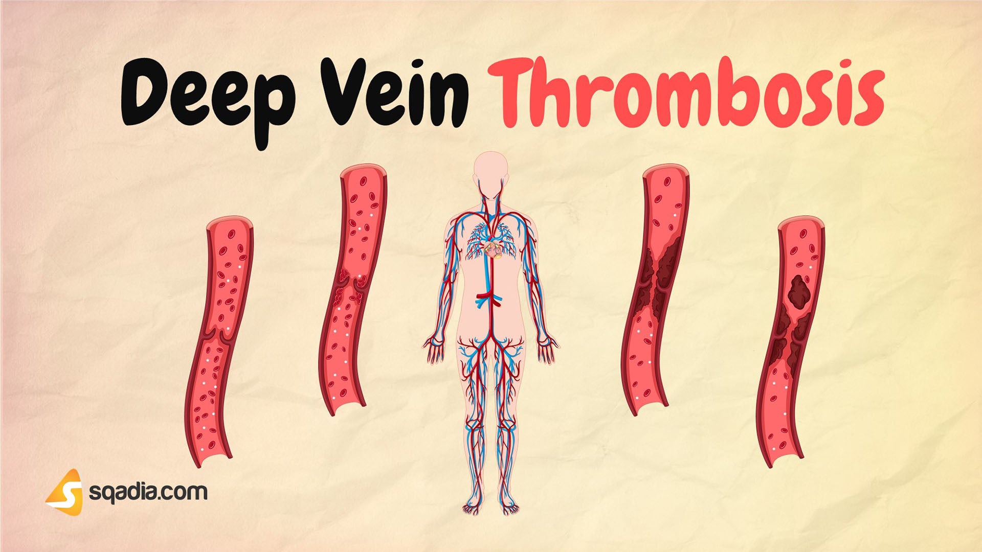 Deep Vein Thrombosis - Introduction