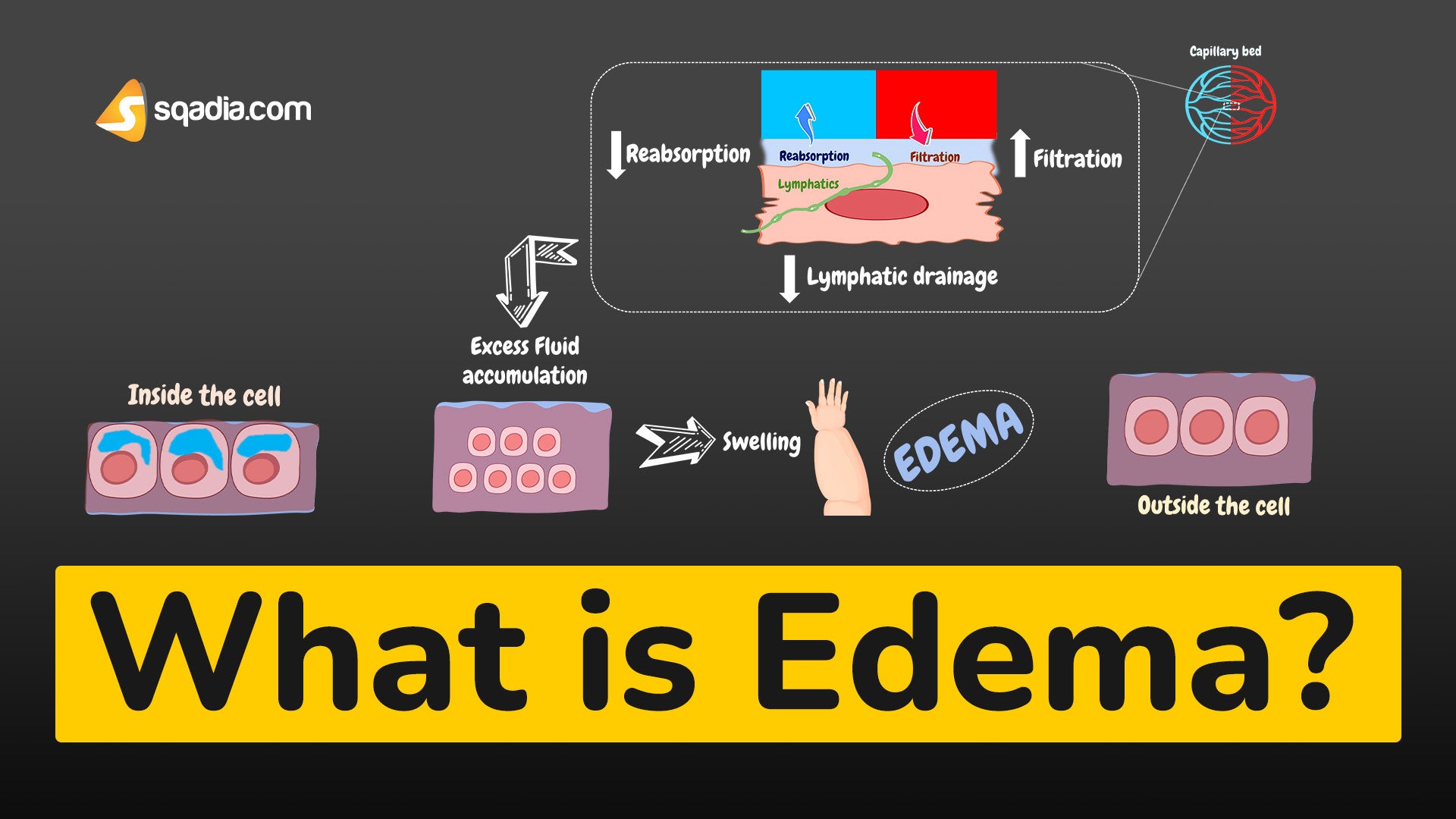 What is edema pathophysiology