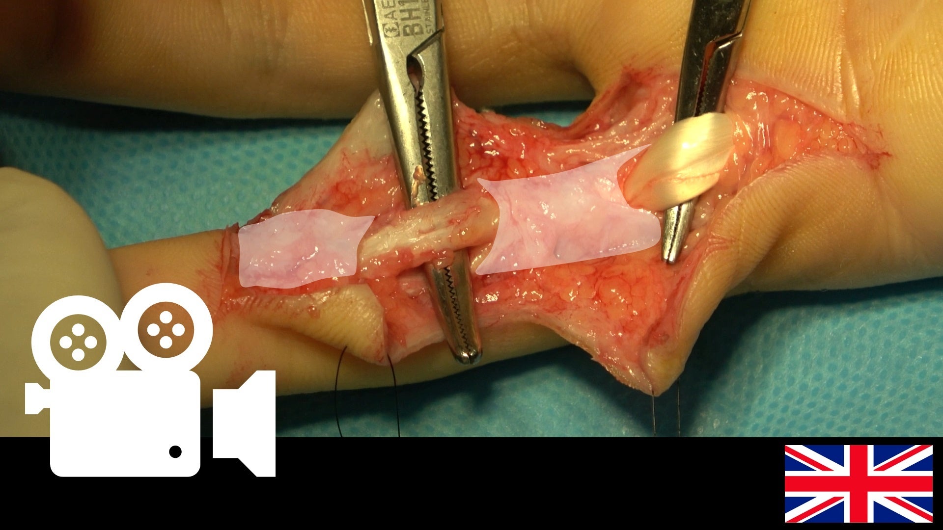 Flexor tendon tenolysis (zone 2)