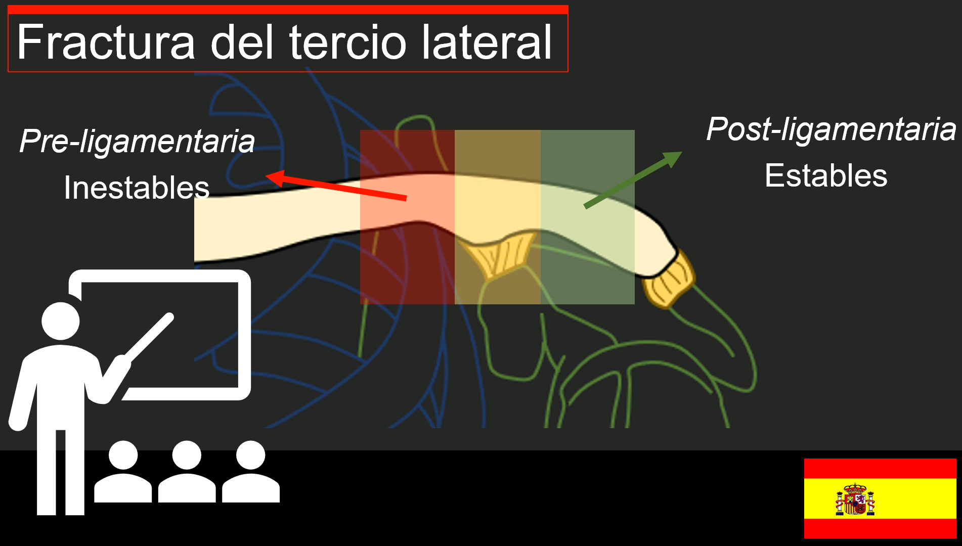 Comprendiendo las Fracturas de Clavícula.