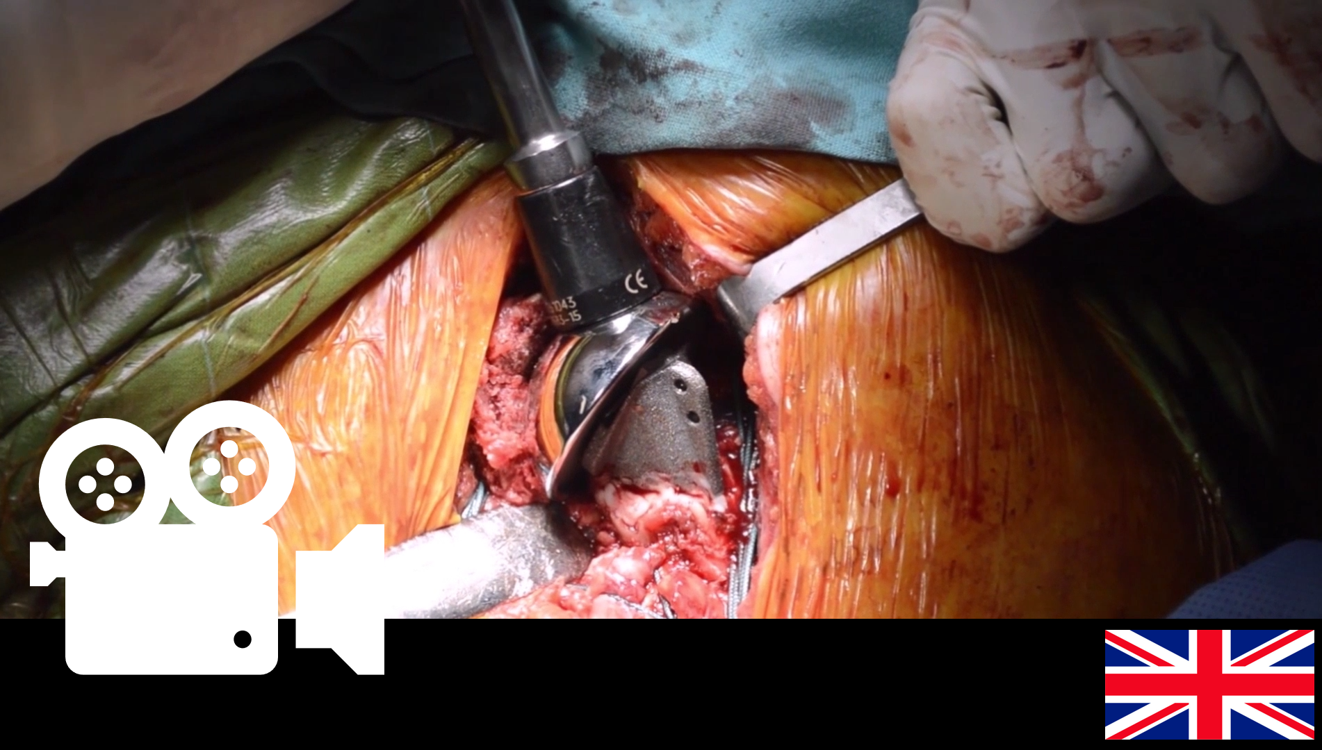 Proximal Humerus Fracture - Hemiarthroplasty.