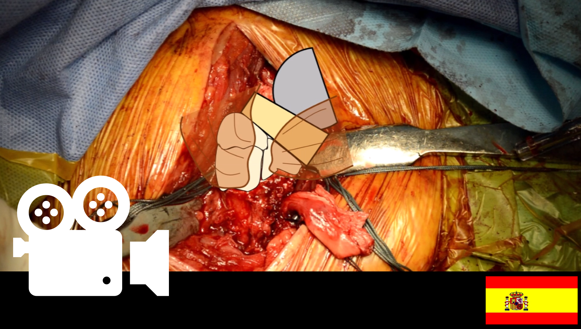 Fractura de húmero proximal a cuatro fragmentos: prótesis reversa de hombro.