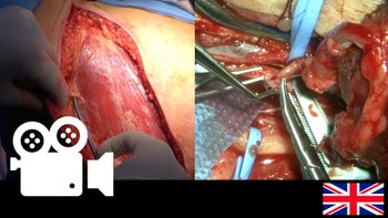 Microsurgical free flap of the latissimus dorsi muscle