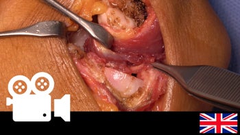 Radiocapitellar Arthritis: Anconeus interposition arthroplasty & lateral ulnar collateral ligament reconstruction.