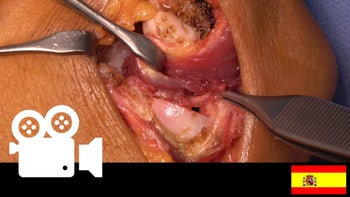 Artropatía radiocapitelar: Artroplastía por interposición del ancóneo & reconstrucción del ligamento lateral húmero-cubital.