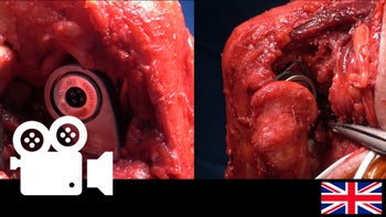 Total elbow arthroplasty: Para-Olecranon Approach