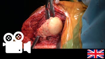 Revision of infected reverse shoulder arthroplasty