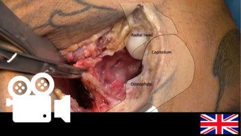 Elbow Stiffness: Column Procedure.