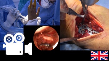 Distal radius fracture: Arthroscopic assisted open reduction and internal fixation
