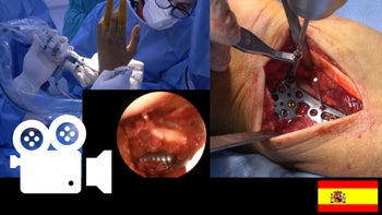 Fractura de radio distal: Abordaje palmar y asistencia artroscópica