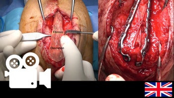 Olecranon Nonunion: Open reduction y open fixation
