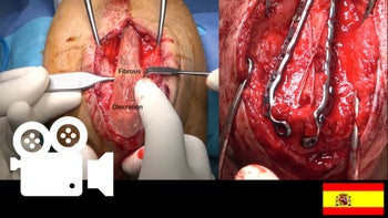 Pseudoartrosis Olécranon: Reducción y osteosíntesis