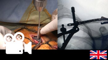 Clavicle fracture: Less invasive plate osteosynthesis