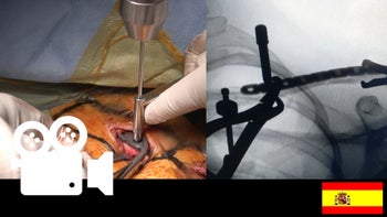 Fractura de clavícula: Reducción y fijación interna menos invasiva