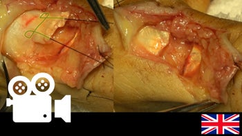 Extensor pollicis longus lesion: Primary repair