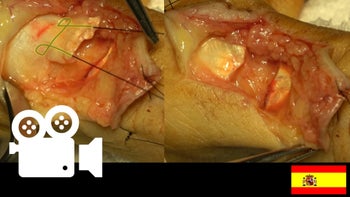 Lesión tendinosa del extensor largo del pulgar.