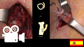 Desgarro parcial del bíceps distal: Cirugía con abordaje único posterior