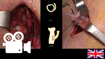 Distal biceps tendon partial tear: Surgical treatment through a singles posterior incision.