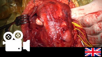 Distal humerus fracture: ORIF using a paratricipital approach