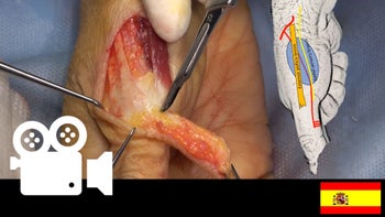 Colgajo dorsoradial homodigital reverso para reconstrucción de tejidos blandos del pulgar
