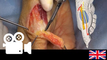 Reverse Homodigital Dorsoradial Flap for Thumb Soft Tissue Reconstruction