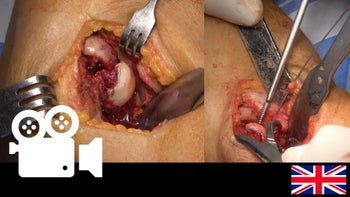 Distal humerus capitellum fracture: Open reduction and internal fixation.