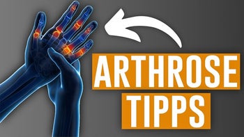 Hilfe bei Arthrose in den Fingern! (Auch Daumen)