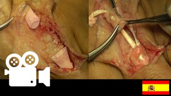 Lesión de tendón extensor común de los dedos en zona 5: Reconstrucción con injerto tendinoso