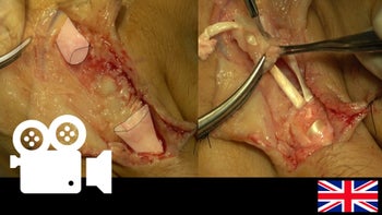 Extensor Tendon Injury in Zone 5: Reconstruction with tendon graft
