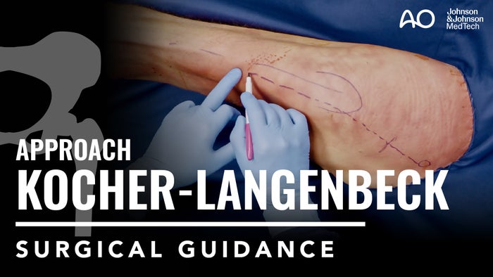 Kocher-Langenbeck Approach to the Acetabulum in Lateral Position