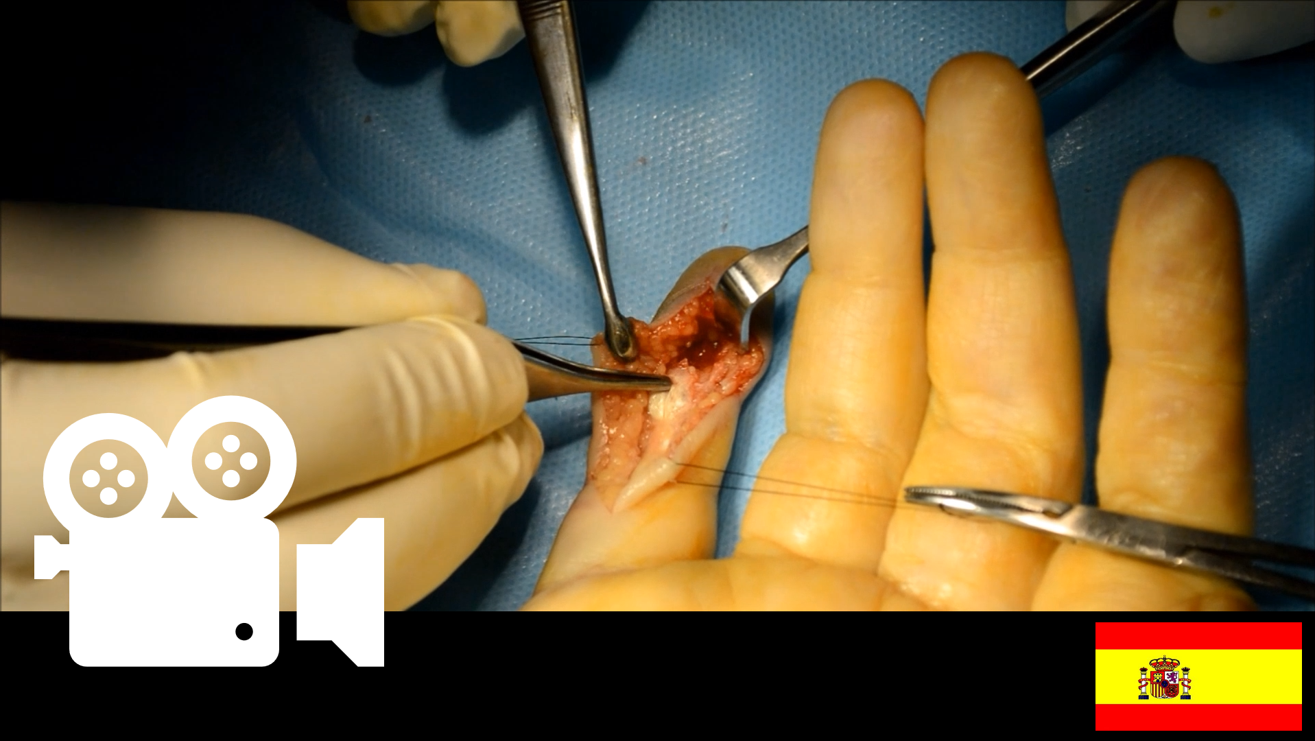 Avulsión ósea del flexor profundo de los dedos (Jersey Finger). Técnica de Pull Out.