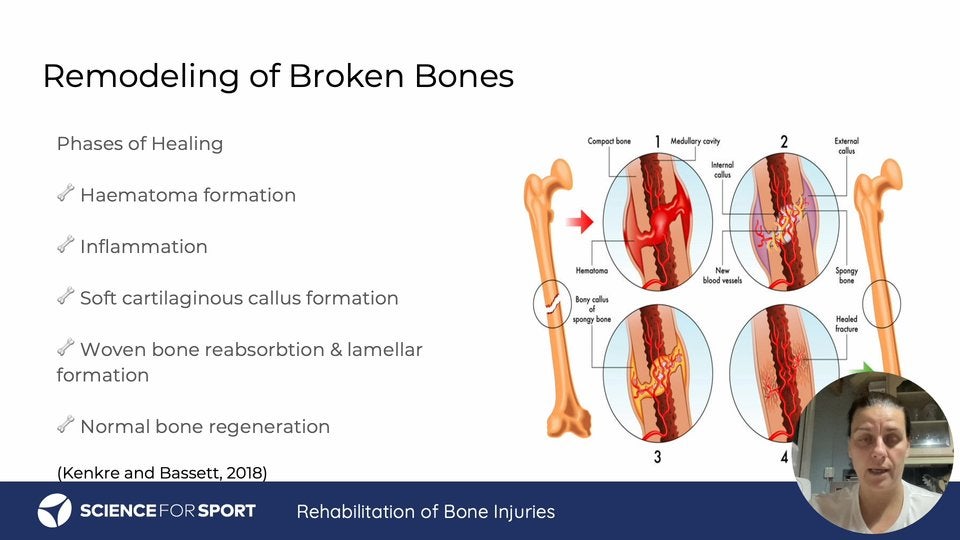 Bone Injuries