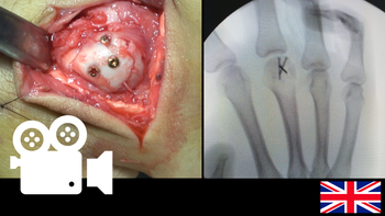 Fracture of the metacarpal head: osteosynthesis using a transtendinous approach.