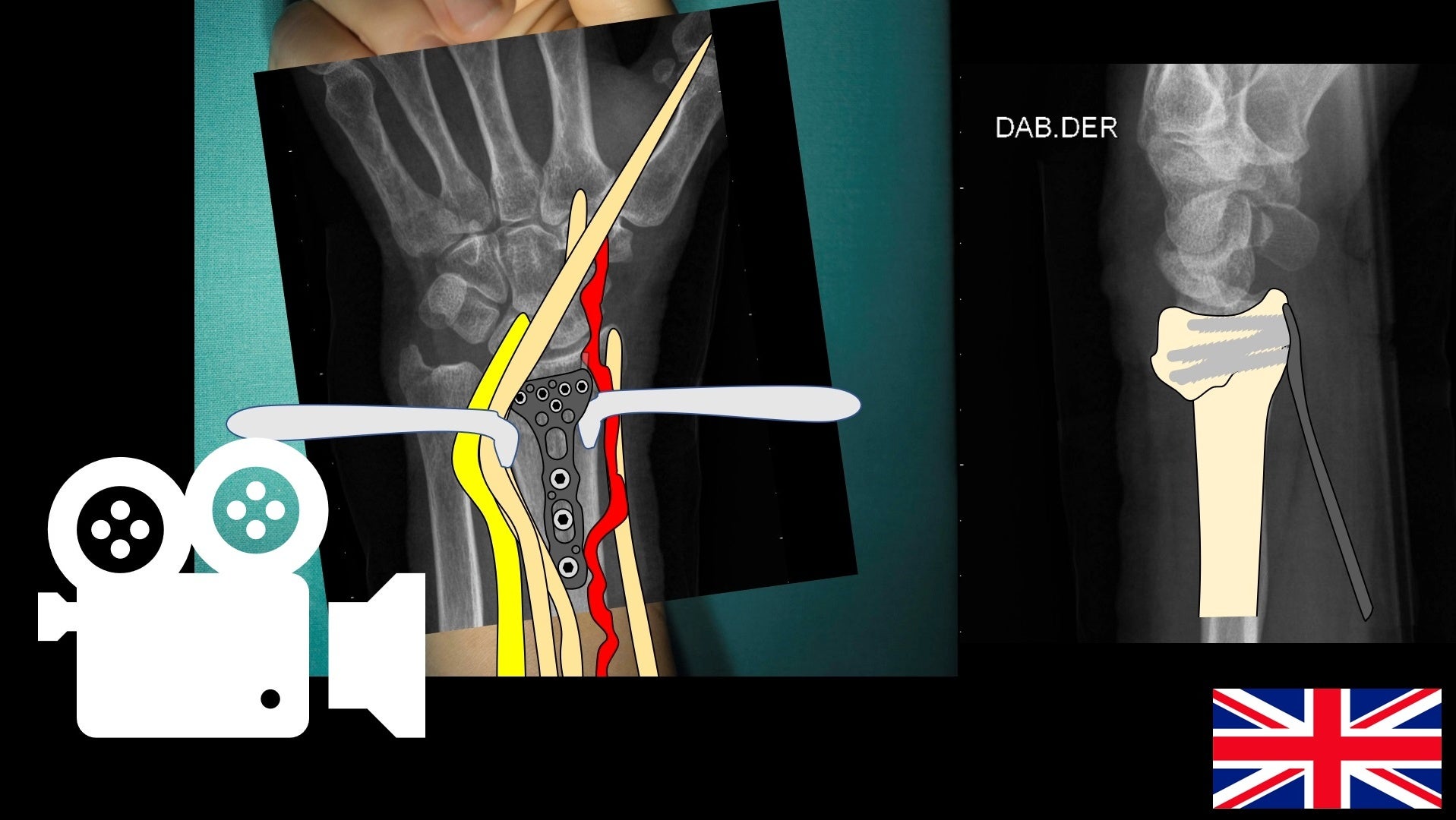 Distal radius fracture: Open reduction and internal fixation. Anterior modified henry approach.