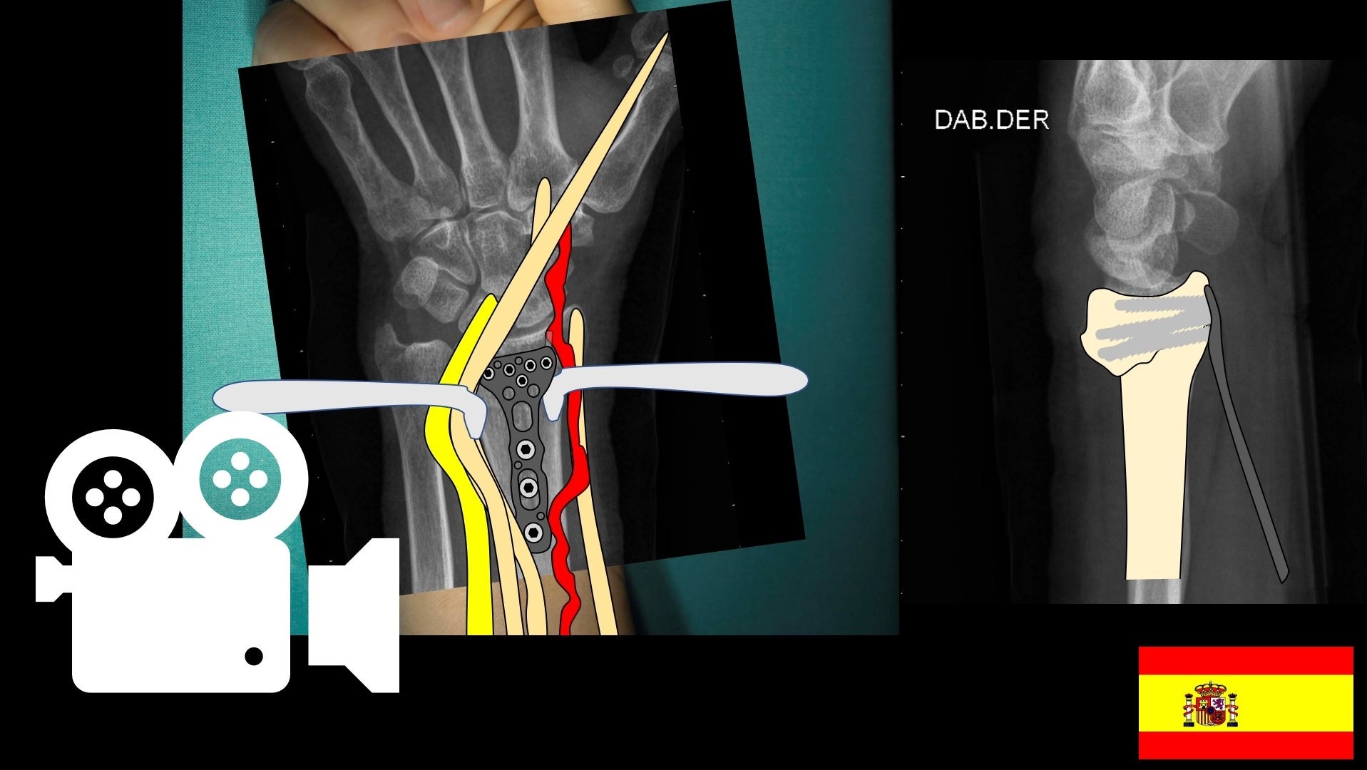 Fractura de radio distal: reducción abierta y fijación interna. Abordaje anterior de henry modificado.